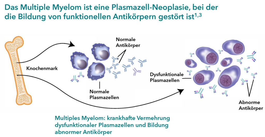 Das Multiple Myelom ist eine Plasmazell-Neoplasie, bei der die Bildung von funktionellen Antikörpern gestört ist